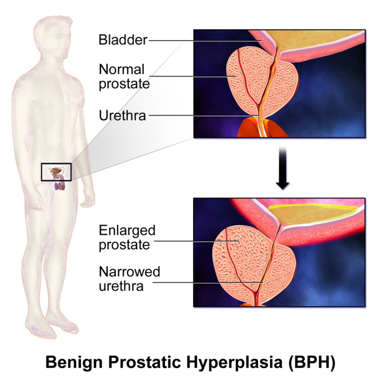 Benign Prostatic Hyperplasia (BPH) — medical illustration
