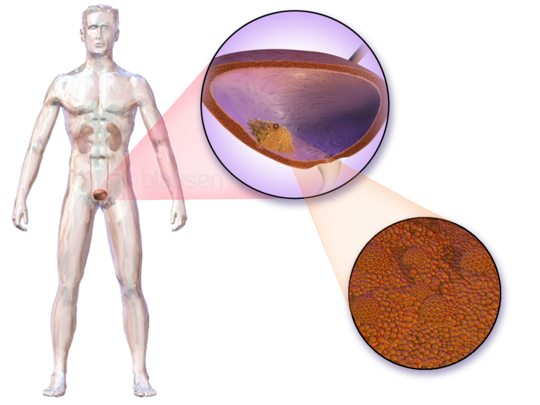 Bladder Cancer — medical illustration