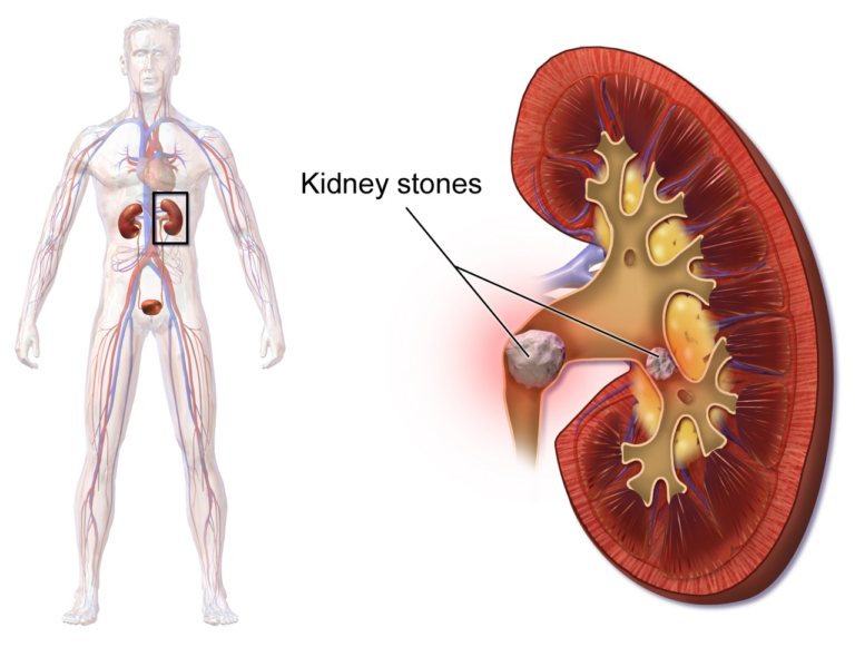Kidney Stones — medical illustration