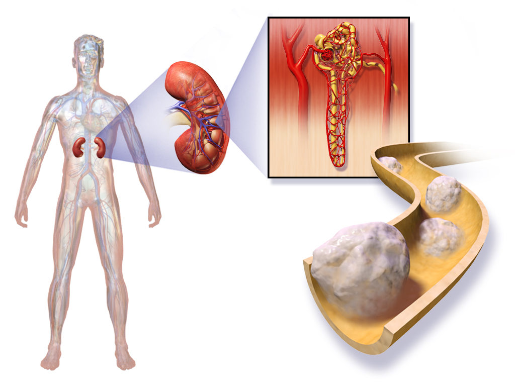 Kidney Cancer — medical illustration