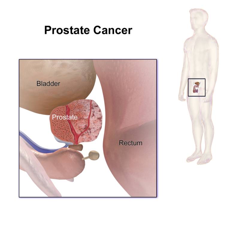 Prostate Cancer — medical illustration
