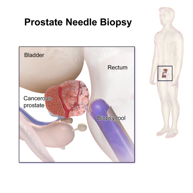 Prostate Needle Biopsy — medical illustration