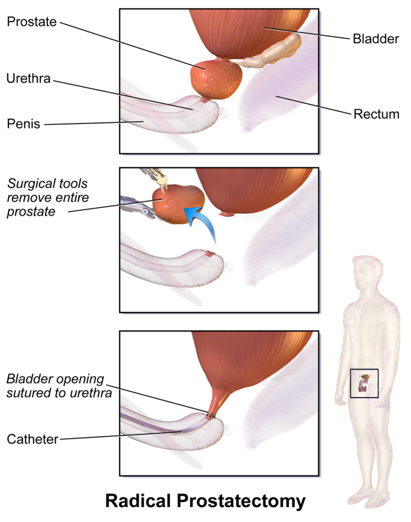 Prostate Removal — medical illustration