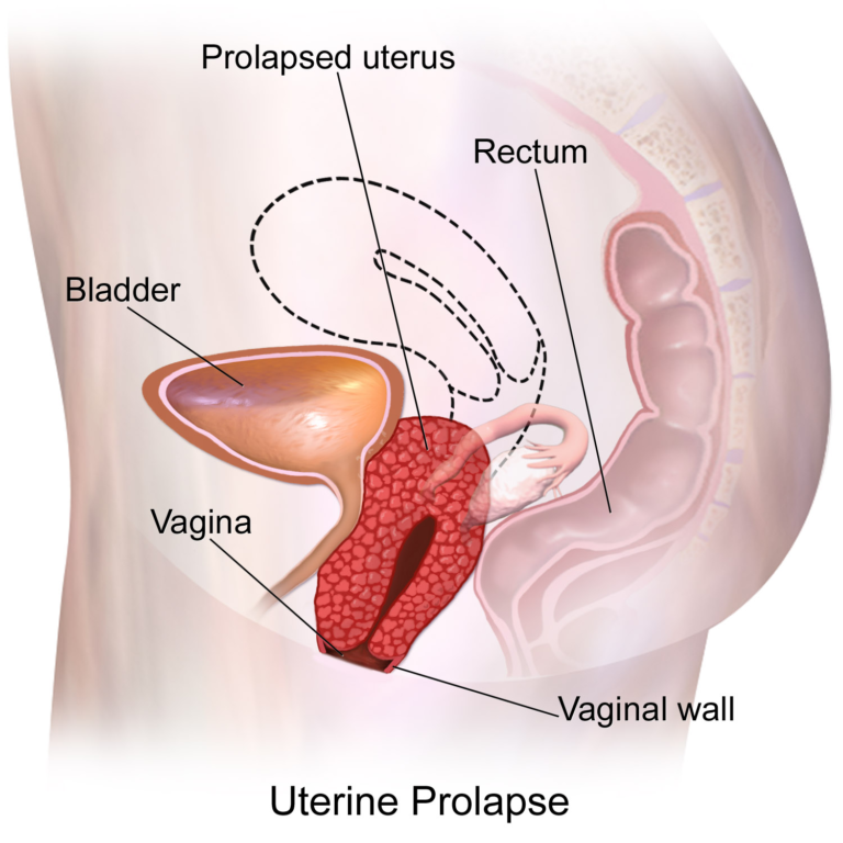 Uterine Prolapse — medical illustration